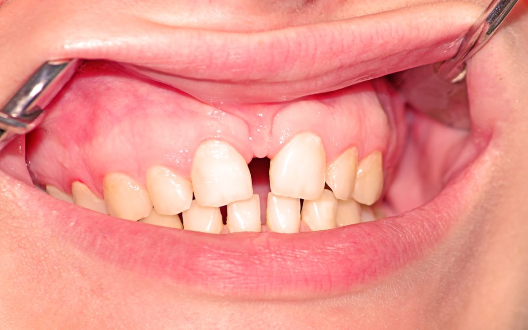 Frenillo labial superior