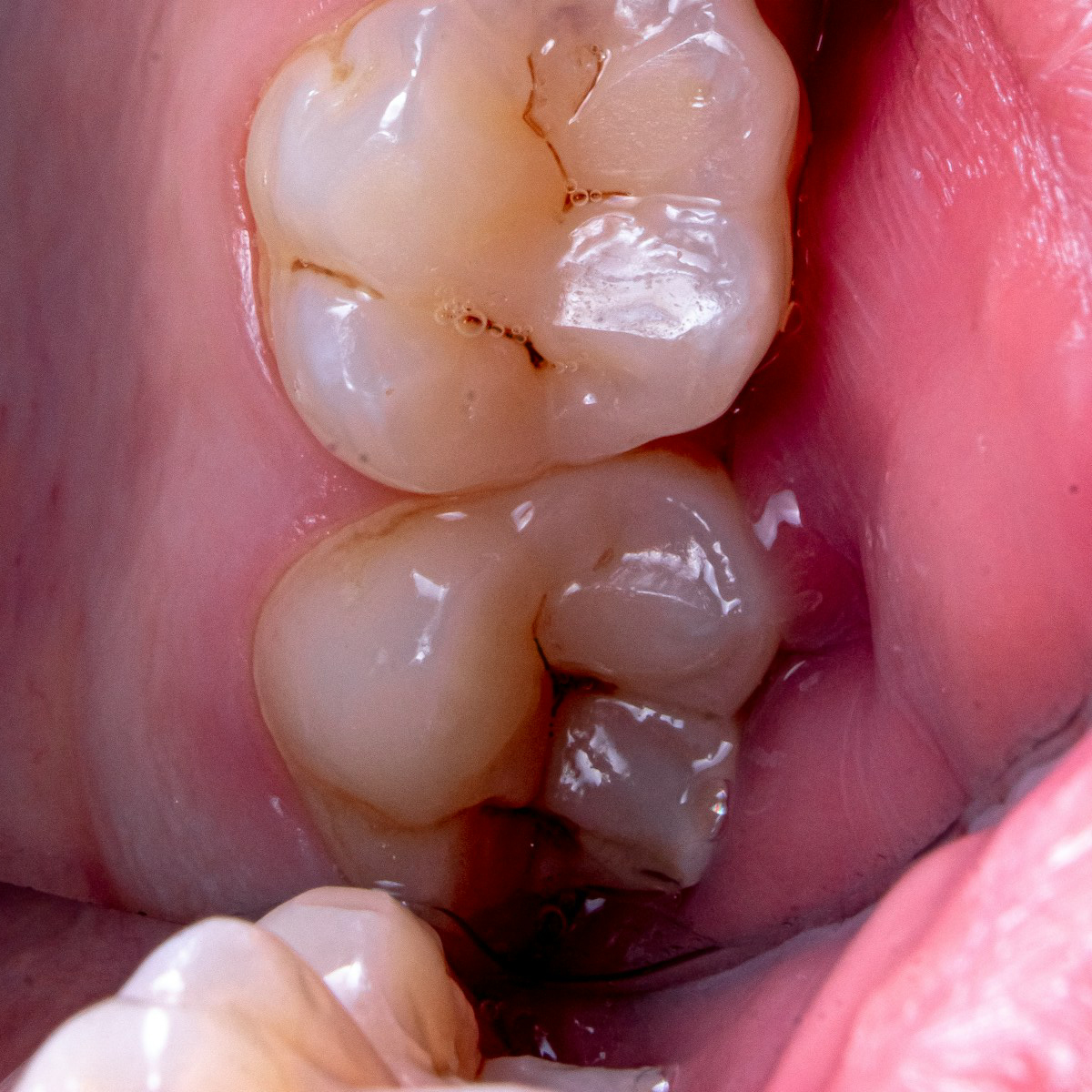 tratamiento de odontología y endodoncia para la caries
