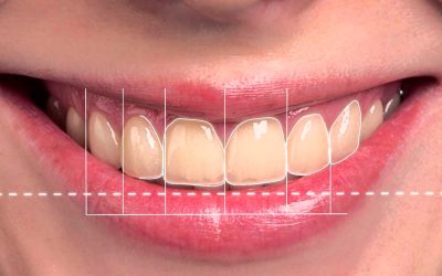Tipos de ortodoncia: cuál es la mejor opción para tu sonrisa