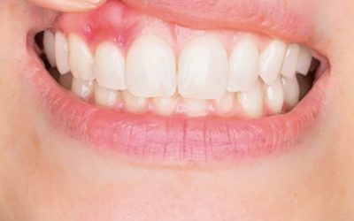 Periodontitis y gingivitis: cómo diferenciar estas enfermedades de las encías